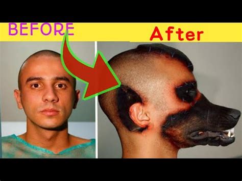 He had marbles implanted in an unusual body part. Now he’s suin.